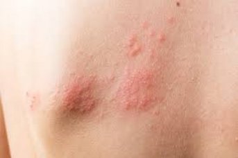 Dermatitis atópica: síntomas y tratamientos de la enfermedad de la piel que afecta a 1 de cada 10 argentinos